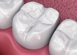 Tooth colored fillings