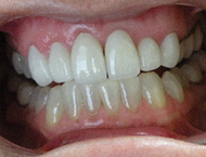 DMC Dental anterior crowns