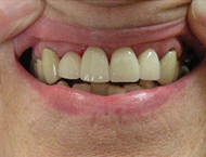 Fayetteville anterior crowns