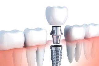 Illustration of dental implant