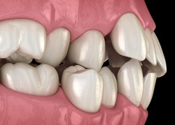 An image of a crossbite 