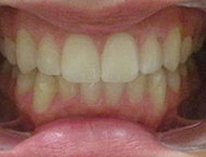 Fayetteville Invisalign