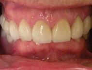 Fayetteville porcelain restorations