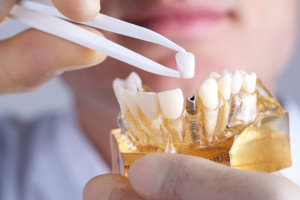 How can dental implants in Fayetteville restore your smile?